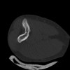 SPORK, NICO - 22.03.1976 - 02.08.2022 - CT obere Extremität - 17:51:17